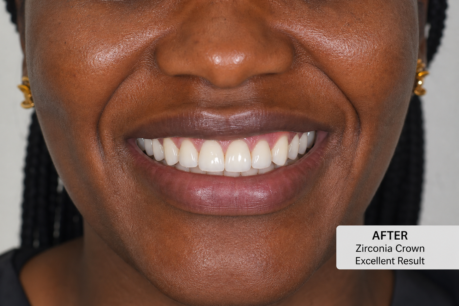 Zirconia Crown Restoration — after