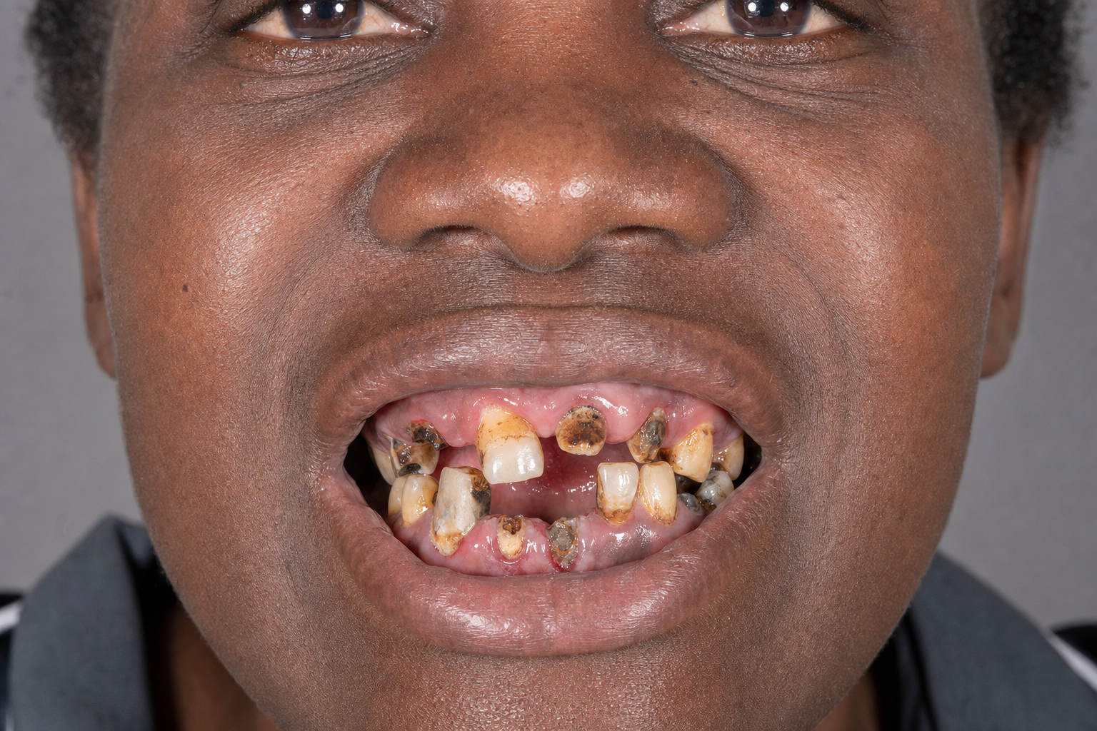 Complete Smile Makeover — before