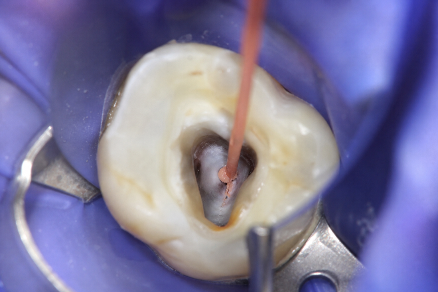 Root Canal Treatment at Riverstone Dental Care, Kampala