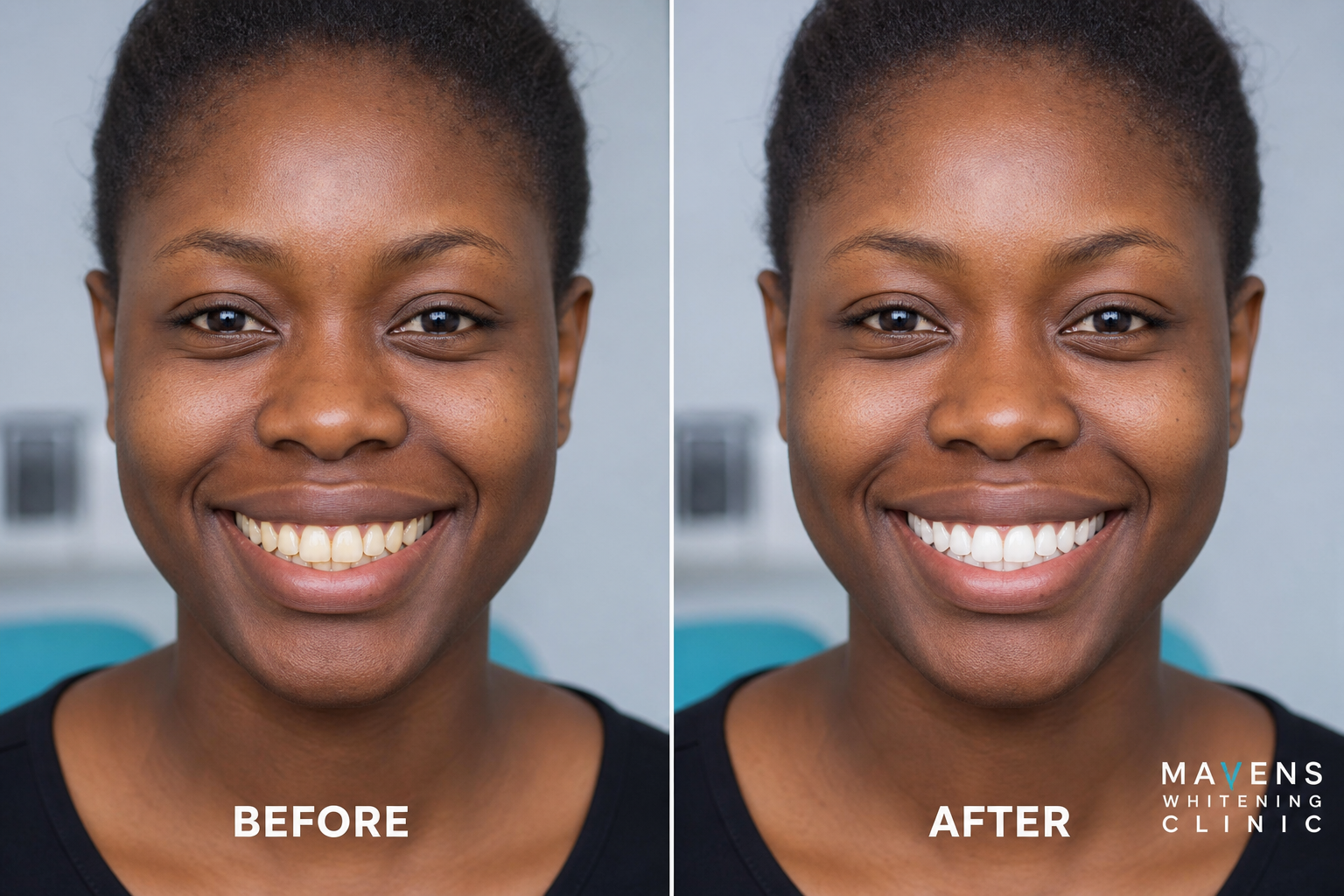 Why choose Teeth Whitening?